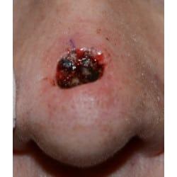 Before Image: Mohs Reconstruction by Dr. Thompson - front