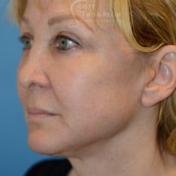 After Image: Facelift | Eyelid Surgery | Jowl Implant | CO2 Laser – 823 - left-front-oblique
