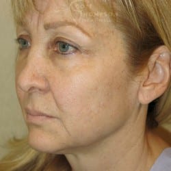 Before Image: Facelift | Eyelid Surgery | Jowl Implant | CO2 Laser – 823 - left-front-oblique