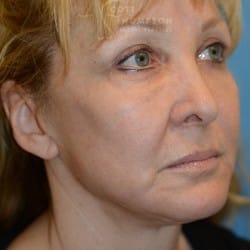 After Image: Facelift | Eyelid Surgery | Jowl Implant | CO2 Laser – 823 - right-front-oblique