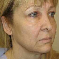 Before Image: Facelift | Eyelid Surgery | Jowl Implant | CO2 Laser – 823 - right-front-oblique