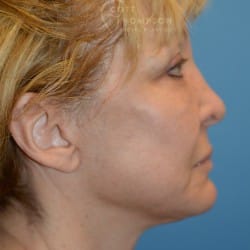 After Image: Facelift | Eyelid Surgery | Jowl Implant | CO2 Laser – 823 - right-side