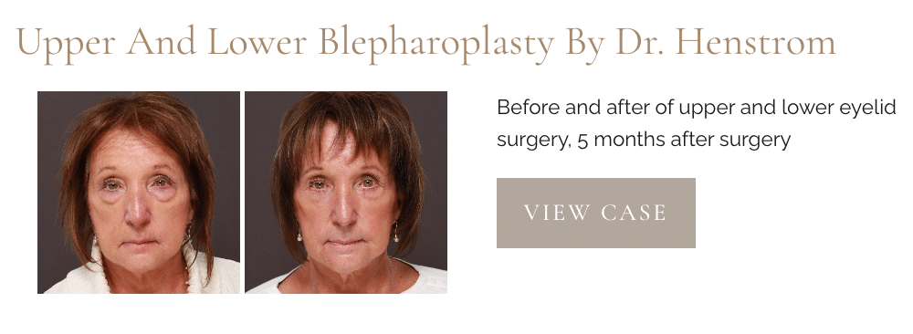 Upper and Lower Blepharoplasty, eyelid lifts, by Dr. Henstrom at Utah Facial Plastics.