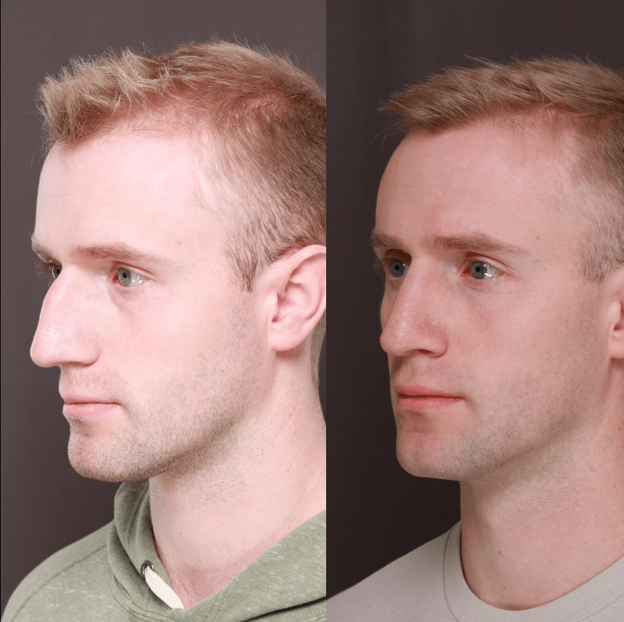 Rinoplastia masculina Utah Facial Plastics