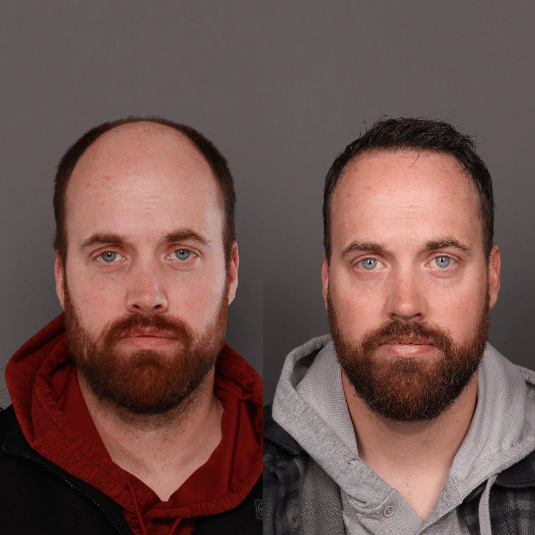 Utah Facial Plastics Heber Facelift Utah Facial Plastics Heber Facelift