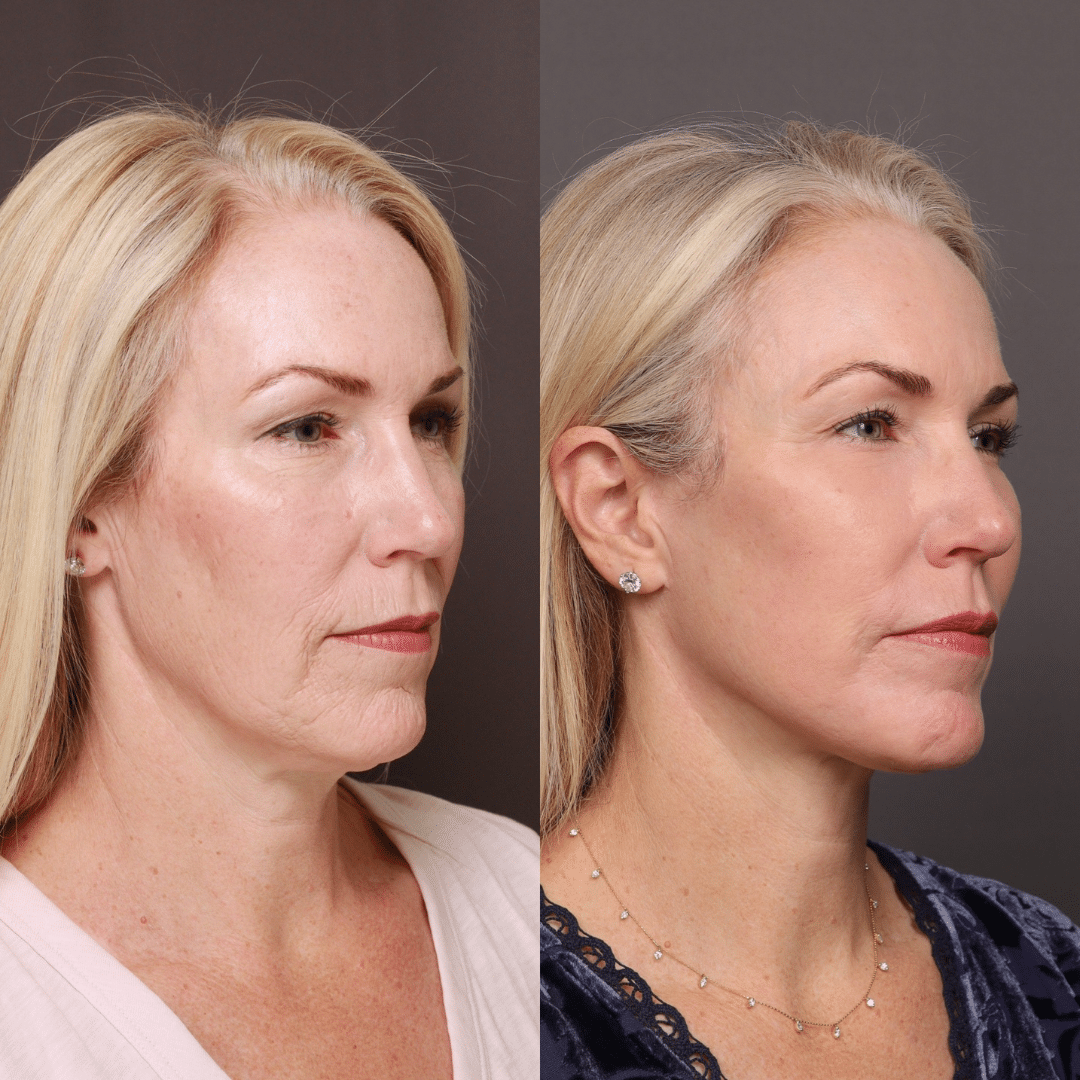 Utah Facial Plastics Heber Facelift (2) Utah Facial Plastics Heber Facelift (2)