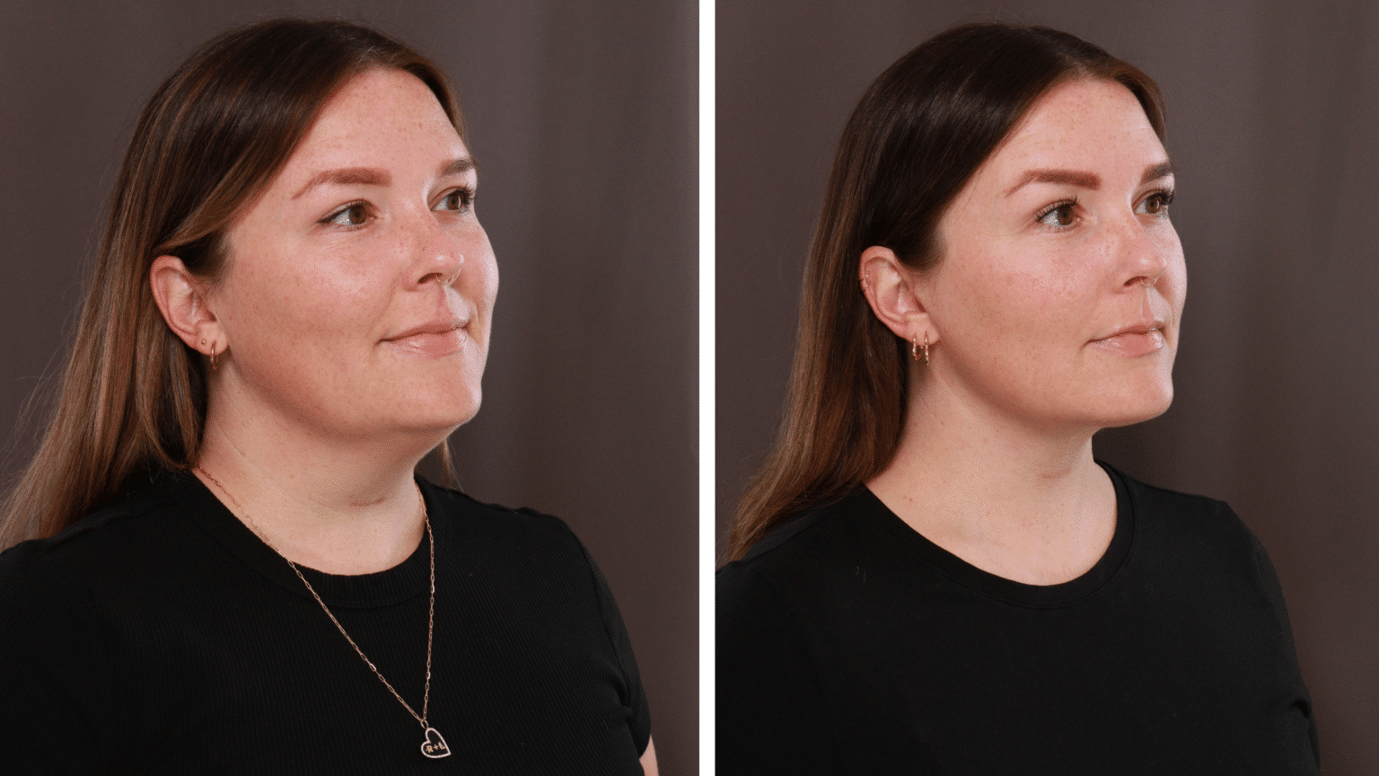 Utah Facial Plastics Jawline Face Contouring 