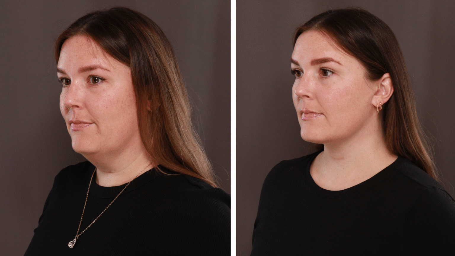 Utah Facial Plastics Jawline Face Contouring 