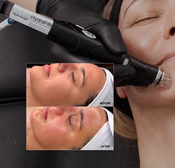 Hydrafacial Results Salt Lake City Utah Hydrafacial Results Salt Lake City Utah