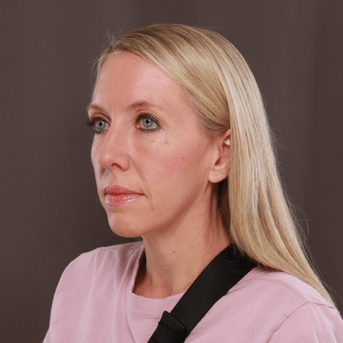 After Image: Lower Blepharoplasty, Skin Pinch, and Fat Grafting by Dr. Henstrom - left-front-oblique