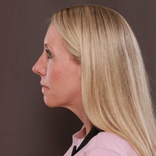 After Image: Lower Blepharoplasty, Skin Pinch, and Fat Grafting - left-side