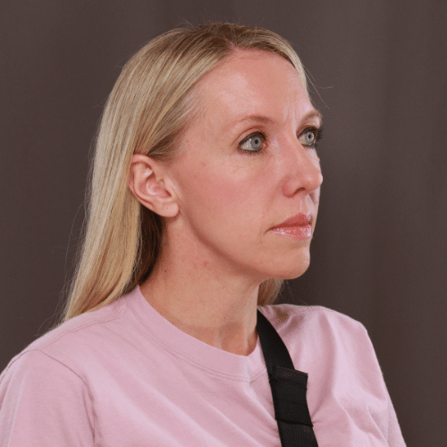 After Image: Lower Blepharoplasty, Skin Pinch, and Fat Grafting - right-front-oblique