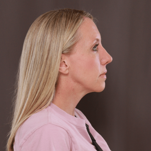 After Image: Lower Blepharoplasty, Skin Pinch, and Fat Grafting - right-side