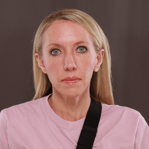 After Image: Lower Blepharoplasty, Skin Pinch, and Fat Grafting - front