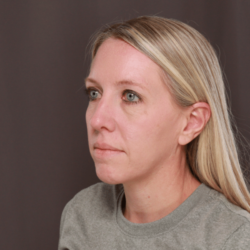 Before Image: Lower Blepharoplasty, Skin Pinch, and Fat Grafting by Dr. Henstrom - left-front-oblique