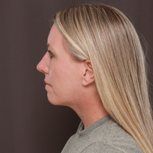 Before Image: Lower Blepharoplasty, Skin Pinch, and Fat Grafting - left-side