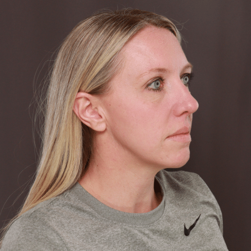 Before Image: Lower Blepharoplasty, Skin Pinch, and Fat Grafting - right-front-oblique