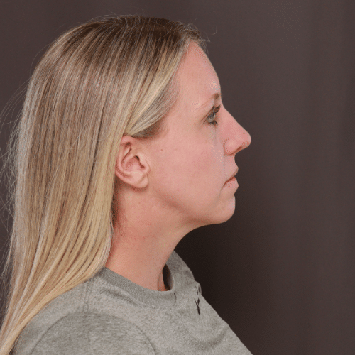 Before Image: Lower Blepharoplasty, Skin Pinch, and Fat Grafting - right-side