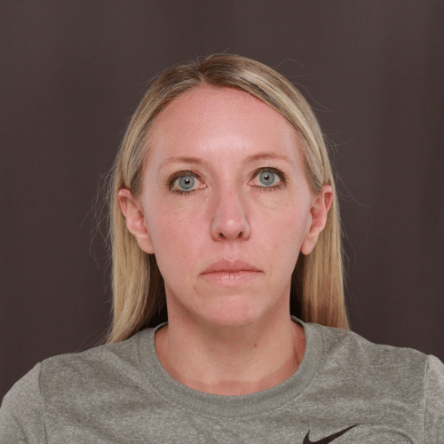 Before Image: Lower Blepharoplasty, Skin Pinch, and Fat Grafting - front