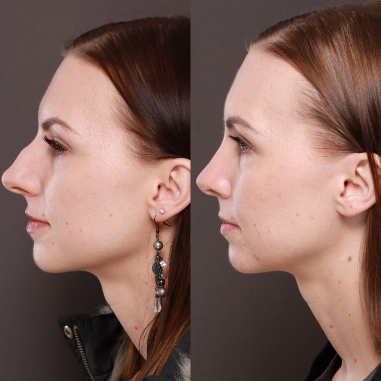 Rhinoplasty Salt Lake City Utah Facial Plastics