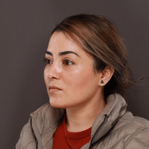 After Image: Septorhinoplasty by Dr. Henstrom - left-front-oblique