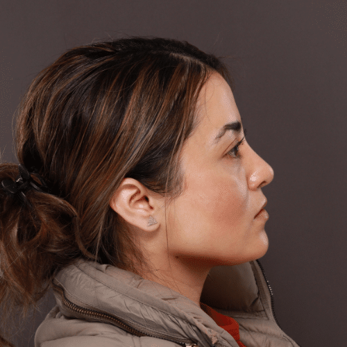 After Image: Septorhinoplasty by Dr. Henstrom - right-side