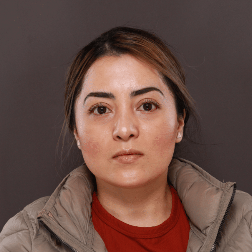 After Image: Septorhinoplasty by Dr. Henstrom - front