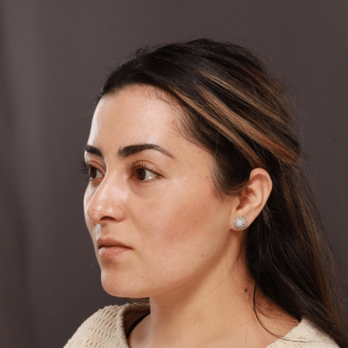 Before Image: Septorhinoplasty by Dr. Henstrom - left-front-oblique