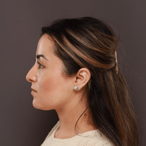 Before Image: Septorhinoplasty by Dr. Henstrom - left-side