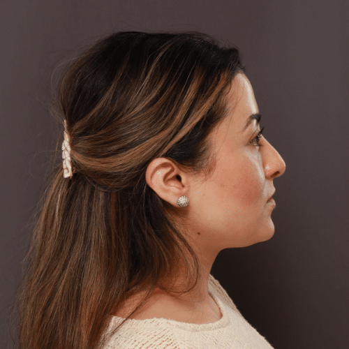 Before Image: Septorhinoplasty by Dr. Henstrom - right-side