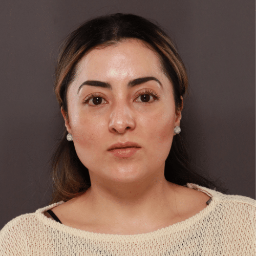 Before Image: Septorhinoplasty by Dr. Henstrom - front