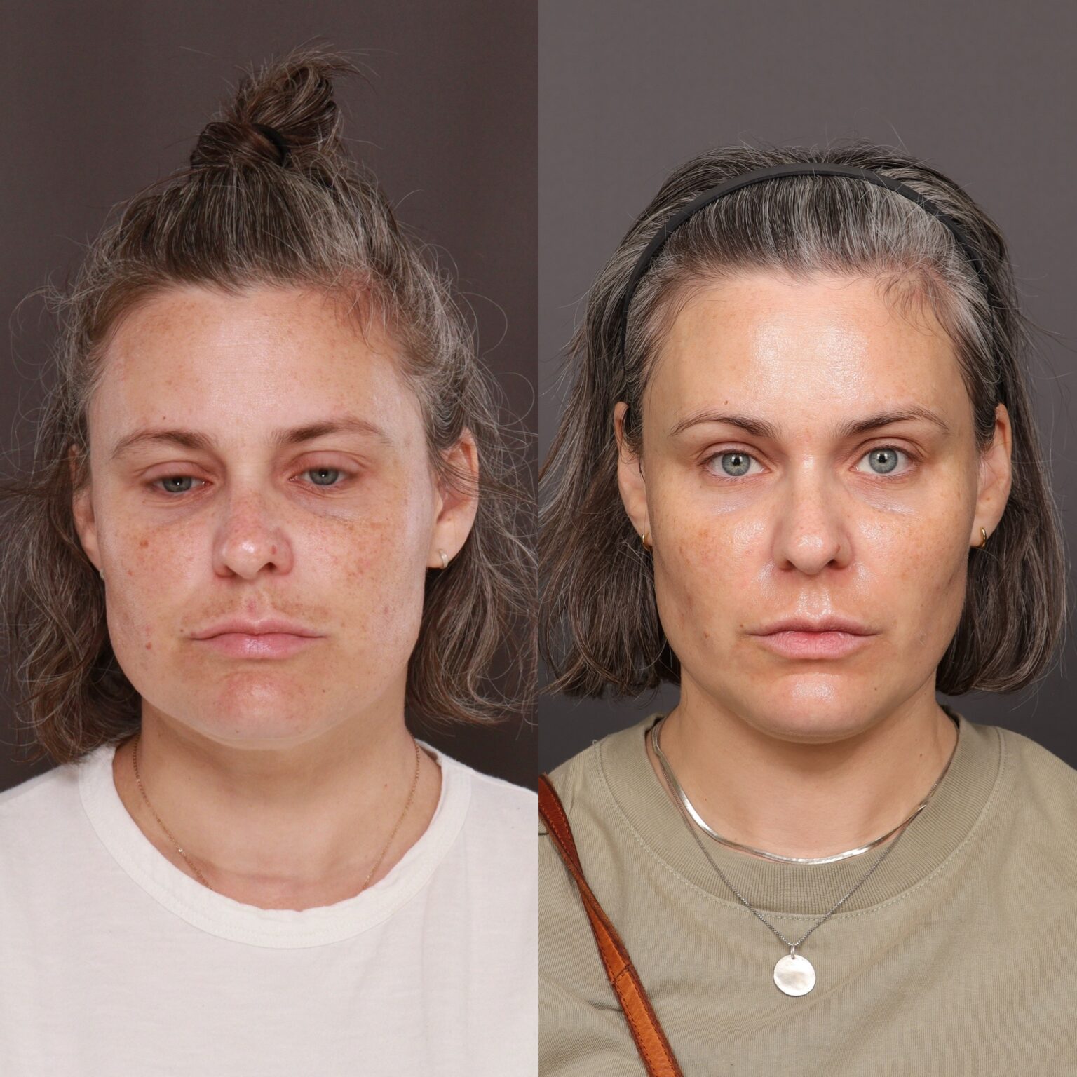 Utah Facial Plastics Moxi Laser Treatment Utah Facial Plastics