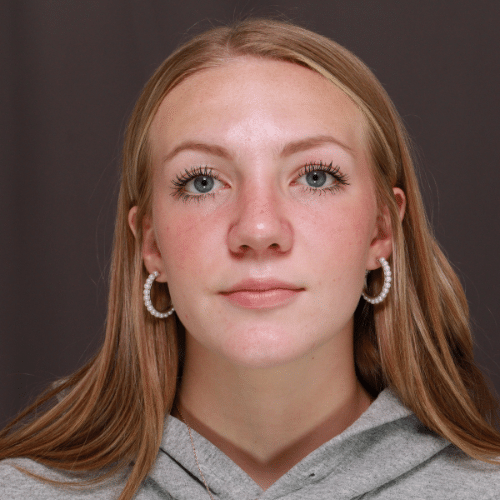 After Image: Rhinoplasty - front