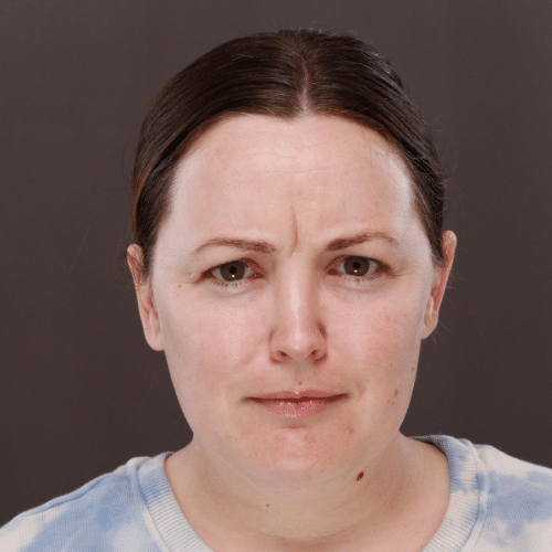 Before Image: Facial Botox - front