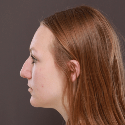 Before Image: Rhinoplasty - left-side