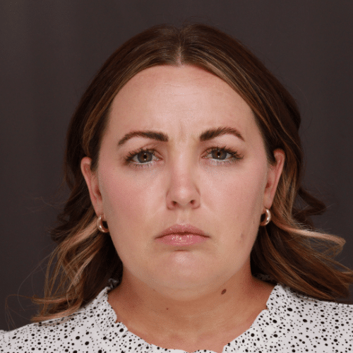 After Image: Facial Botox - front