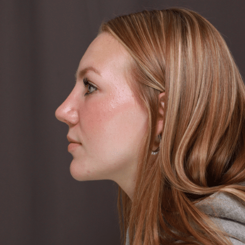 After Image: Rhinoplasty - left-side