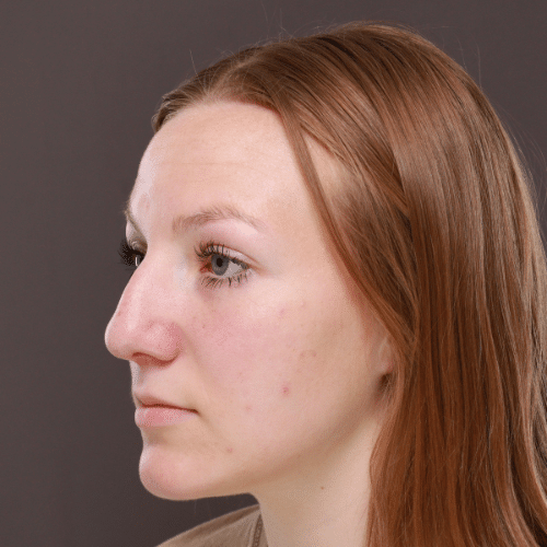 Before Image: Rhinoplasty - left-front-oblique