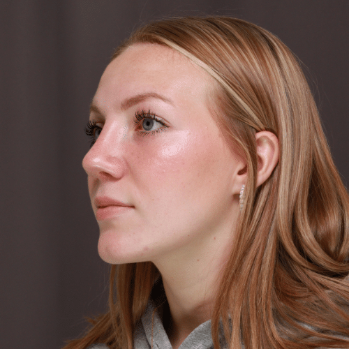 After Image: Rhinoplasty - left-front-oblique