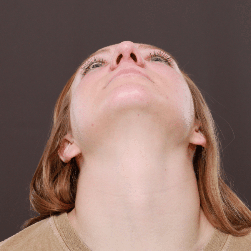 Before Image: Rhinoplasty - front