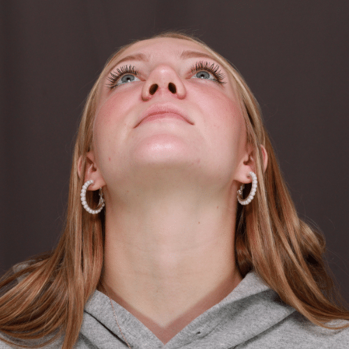 After Image: Rhinoplasty - front