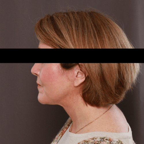 After Image: Facelift, Lower Bleph with Fat Graft Contour TRL - left-side
