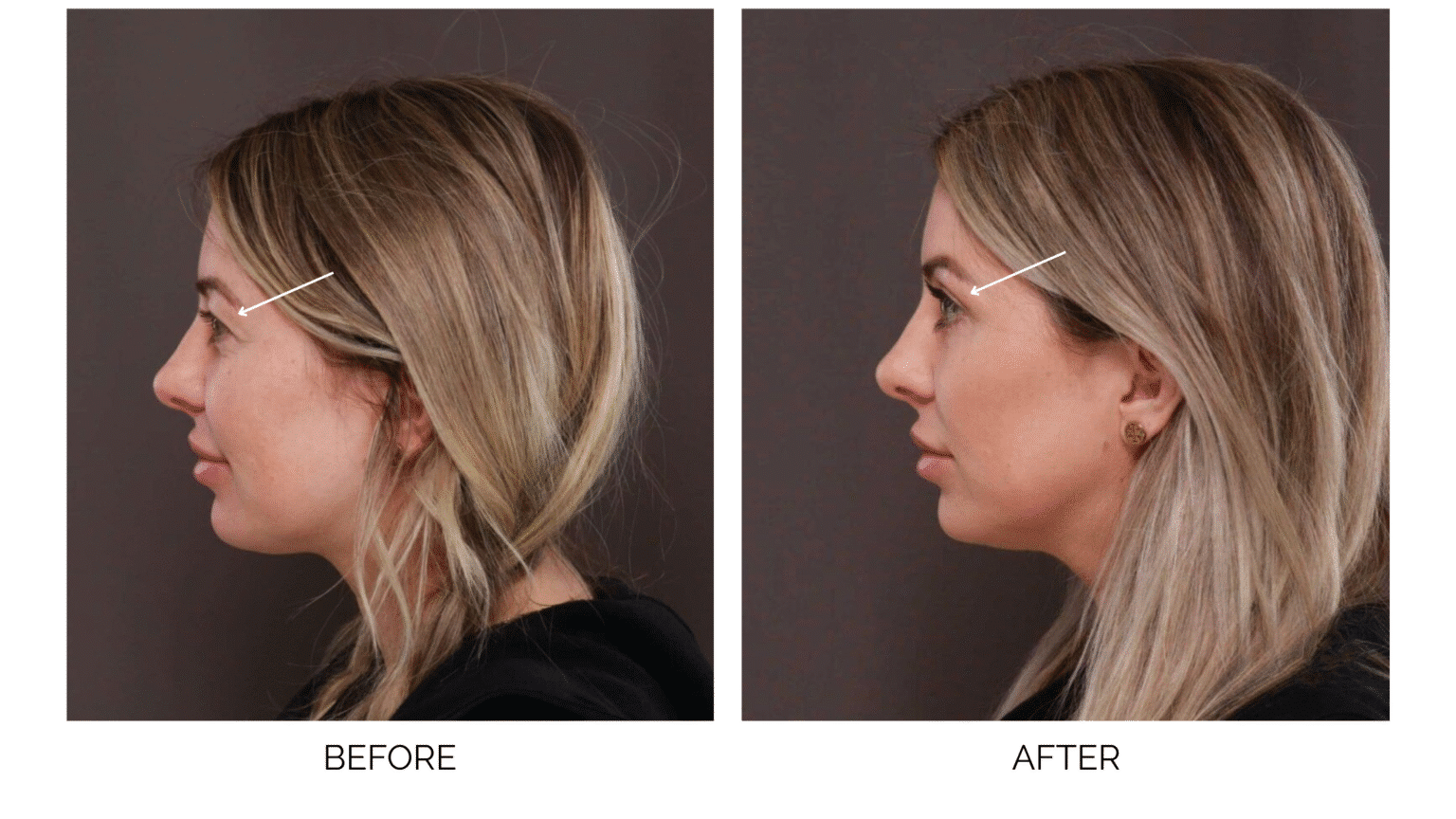 Blepharoplasty Utah Facial Plastics