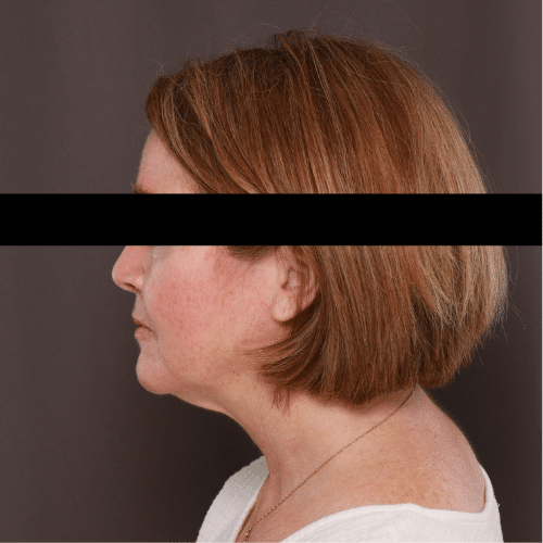 Before Image: Facelift, Lower Bleph with Fat Graft Contour TRL - left-side