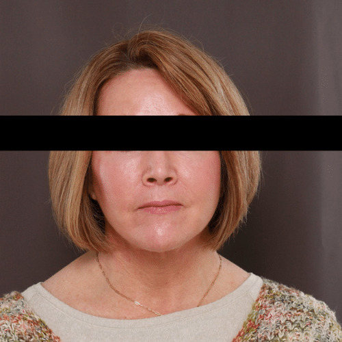 After Image: Facelift, Lower Bleph with Fat Graft Contour TRL - front