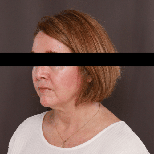 Before Image: Facelift, Lower Bleph with Fat Graft Contour TRL - left-front-oblique