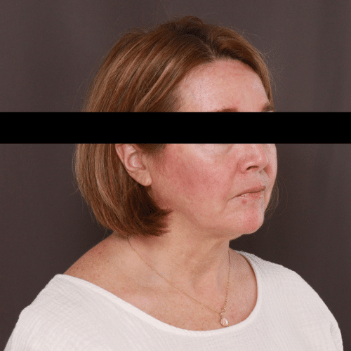 Before Image: Facelift, Lower Bleph with Fat Graft Contour TRL - right-front-oblique
