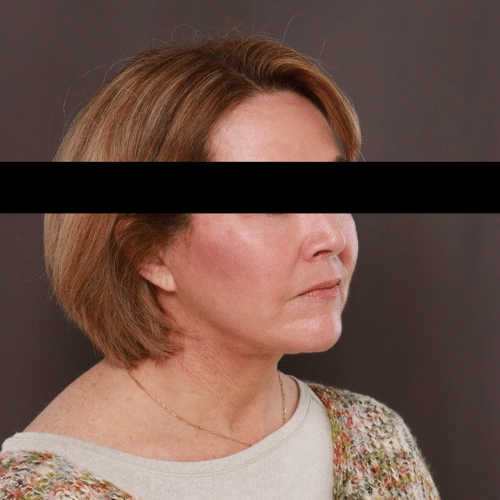 After Image: Facelift, Lower Bleph with Fat Graft Contour TRL - right-front-oblique
