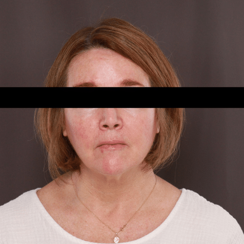 Before Image: Facelift, Lower Bleph with Fat Graft Contour TRL - front