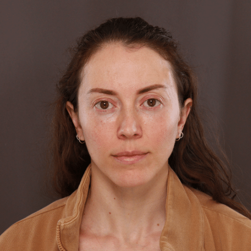 After Image: Fat Grafting & Lower Blepharoplasty - front